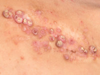 Syringocystadenoma papilliferum