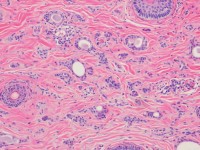 Histologie van syringoma met kikkervisjes (tadpoles)