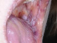 Purpura bij amyloidose