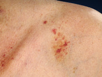 Purpura bij amyloidose