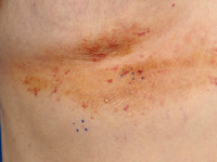 Purpura bij amyloidose