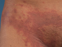 Purpura bij amyloidose