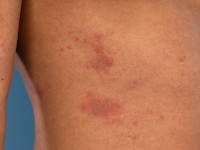 Purpura bij amyloidose