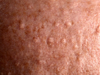 Sebaceous gland hyperplasia