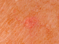 Talgklier hyperplasie