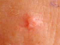 Talgklier hyperplasie