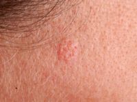 Sebaceous gland hyperplasia