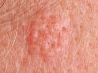 Sebaceous gland hyperplasia