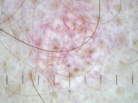 Sebaceous gland hyperplasia