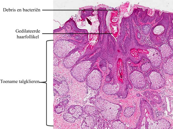 Talgklierhyperplasie