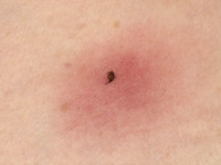 Teek vastgebeten in de huid