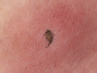 Teek vastgebeten in de huid