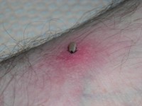 tick bitten into the skin