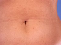 Telangiectasia macularis eruptiva perstans