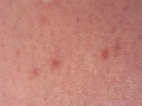 Telangiectasia macularis eruptiva perstans