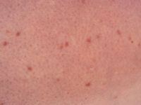 Telangiectasia macularis eruptiva perstans