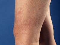 Telangiectasia macularis eruptiva perstans