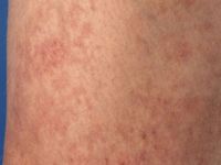 Telangiectasia macularis eruptiva perstans