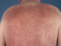 Telangiectasia macularis eruptiva perstans