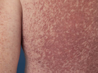 Telangiectasia macularis eruptiva perstans