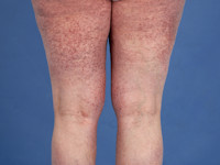 Telangiectasia macularis eruptiva perstans