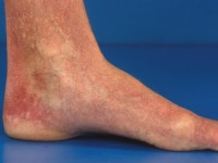 Essentiële teleangiëctasieën