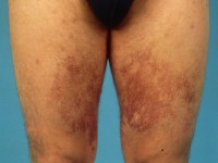 Essentiële teleangiëctasieën