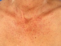 Essentiële teleangiëctasieën