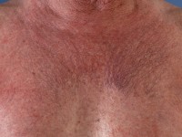 Essentiële teleangiëctasieën