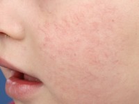 Essentiële teleangiëctasieën