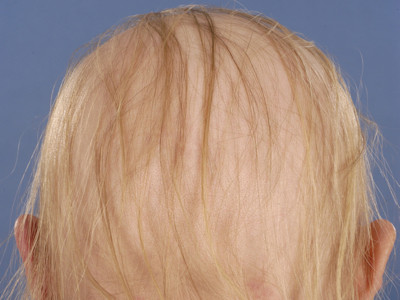 Telogen hair loss