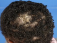 Fungal infection hairy head