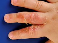 Tinea manuum