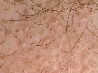 Black dots type tinea capitis