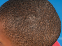 Diffuse scaling type tinea capitis