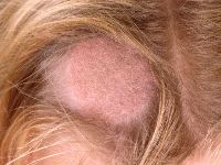 Grey patch type tinea capitis