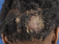 Kerion type tinea capitis