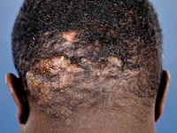Diffuus pustuleus type tinea capitis