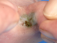 Toeweb infection