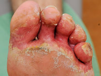 Toeweb infection