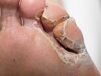 Toeweb infection