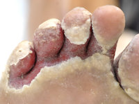 Toeweb infection
