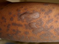 Toxic epidermal necrolysis (TEN)