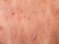 Toxische epidermale necrolyse (TEN)