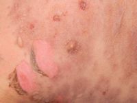 Toxic epidermal necrolysis (TEN)