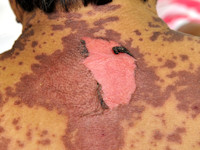 Toxic epidermal necrolysis (TEN)