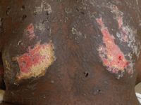 Toxic epidermal necrolysis (TEN)