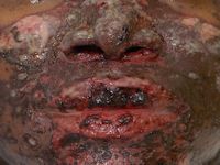 Toxic epidermal necrolysis (TEN)