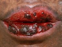 Toxic epidermal necrolysis (TEN)