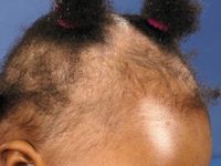 Tractie alopecia